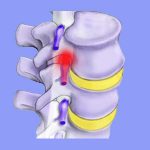 Nerve Root Compression - Sciatica