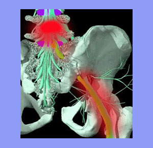 Sciatic Nerve Decompression