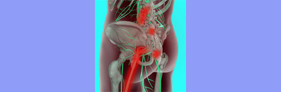 chronic sciatica