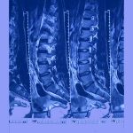 ct scan for sciatica