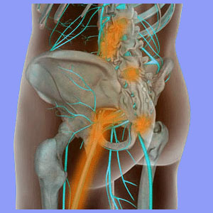 Ultrasound for Sciatica